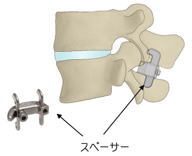 棘突起間スペーサー